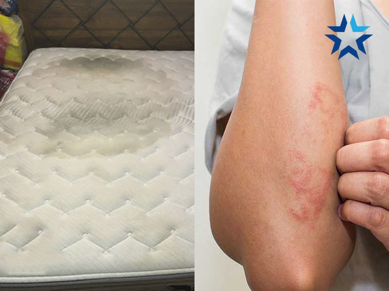 Tay phát ban do nằm đệm bị nấm mốc